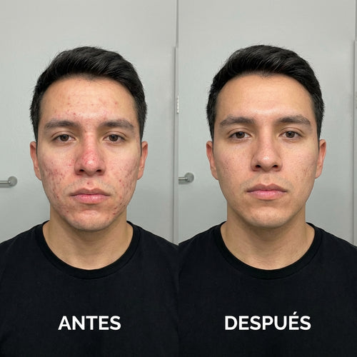 Vitalora™ - Suero Anti Acné Facial con Péptido de Cobre